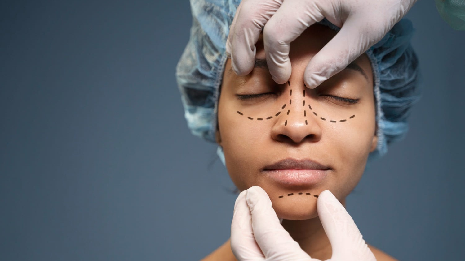 Markeringen op gezicht voor neusverkleining om vorm en verhoudingen vooraf te bepalen