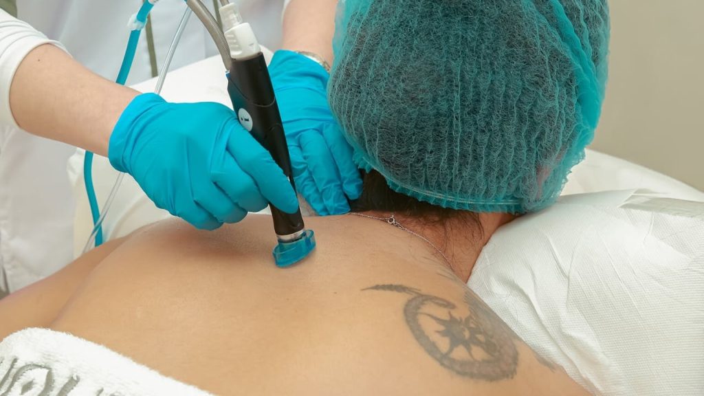 Tattoo verwijderen mislukt 