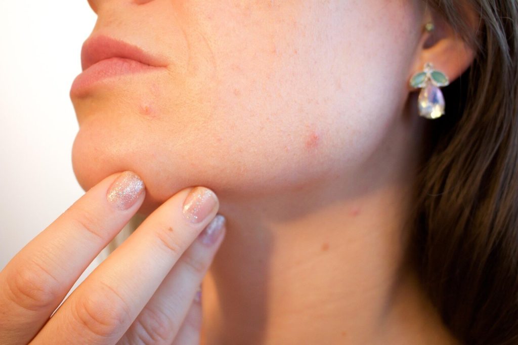 Persoon bekijkt onzuiverheden op de kin tijdens herstel van acne littekens.