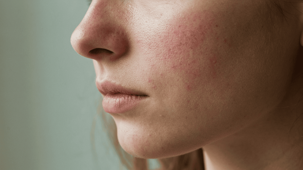 rosacea huid van dichtbij